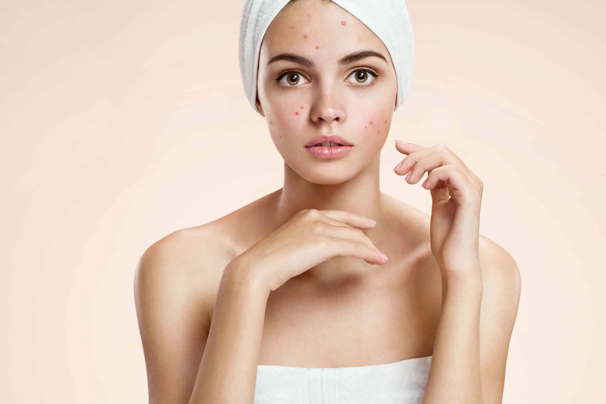 Acne Treatment in Horseshoe Bay, TX at Infused Med Spa