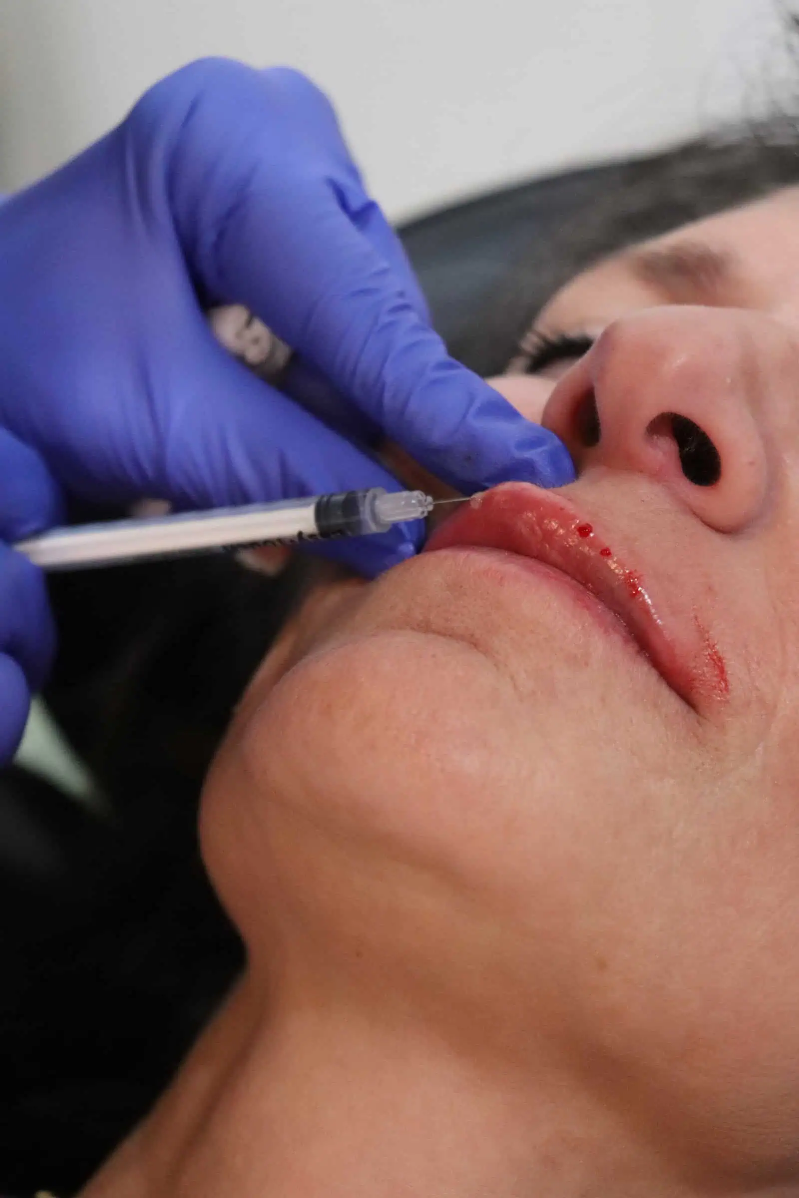 Dermal Fillers a non surgical treatment at Infused Med Spa